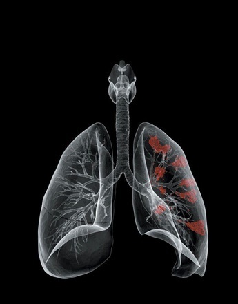 How smoking affect the lungs
