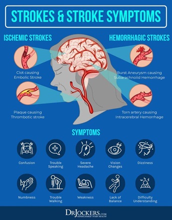 Strokes and stroke symptoms
